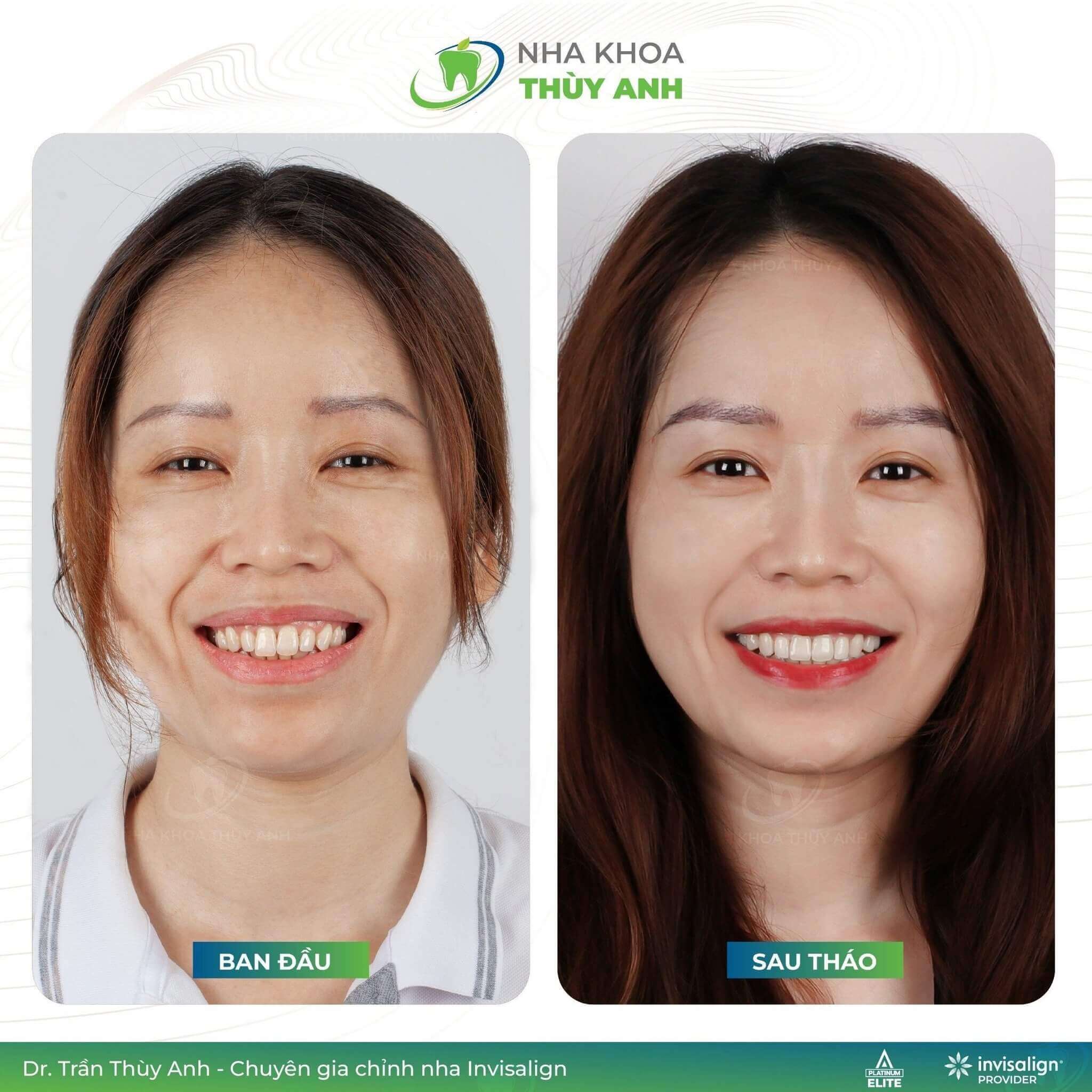 Niềng răng trong suốt Invisalign giá bao nhiêu?
