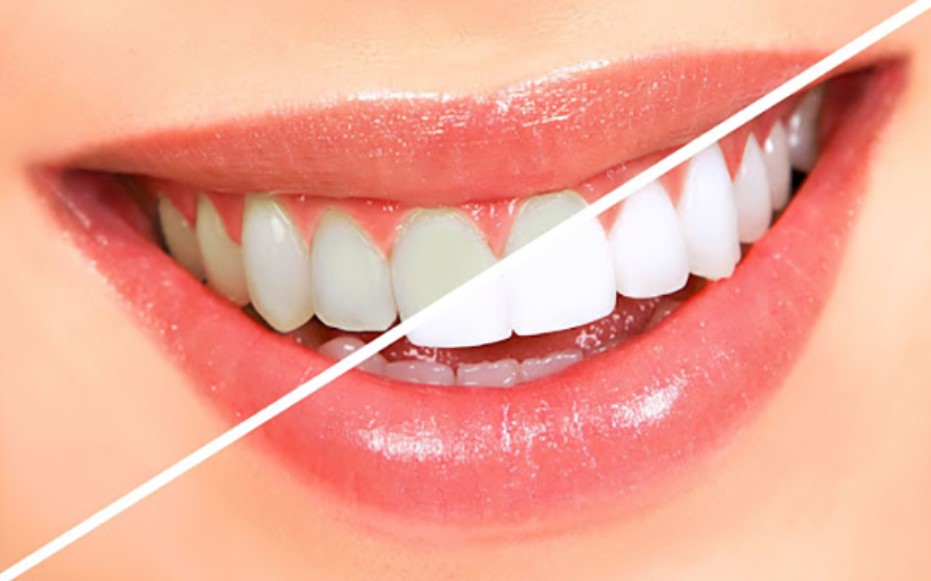 Phục Hình Răng Sứ Là Gì? Các Phương Pháp Phục Hình Răng Sứ Hiện Nay